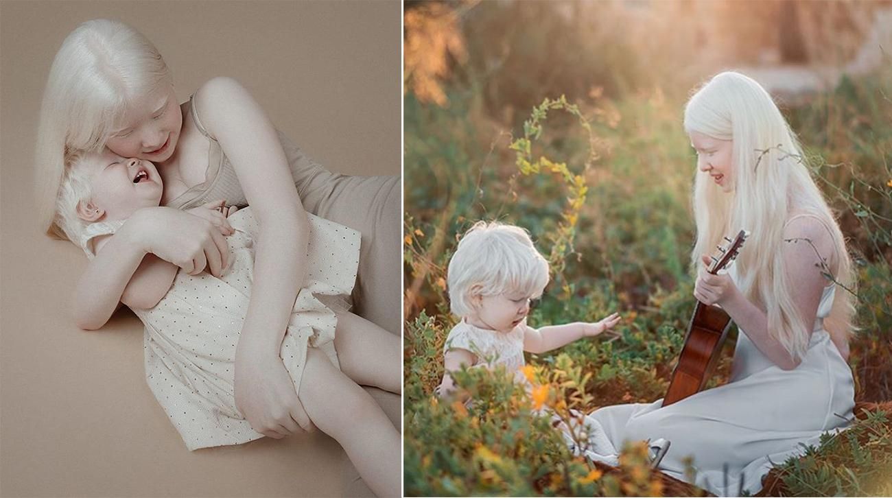 Сестри із альбінізмом зачарували світ своєю красою: захопливі фото, які вразять кожного