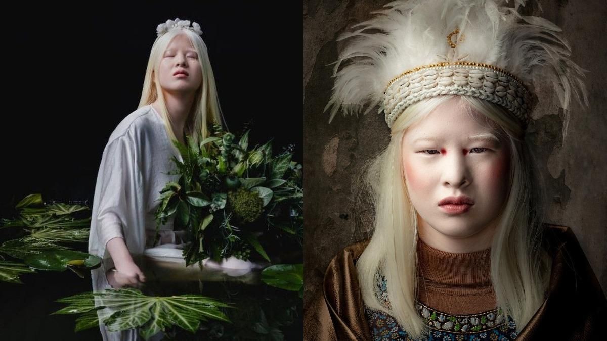 Батьки залишили доньку через хворобу: як вона змогла підкорити Vogue Батьки залишили доньку через хворобу: як вона змогла підкорити Vogue