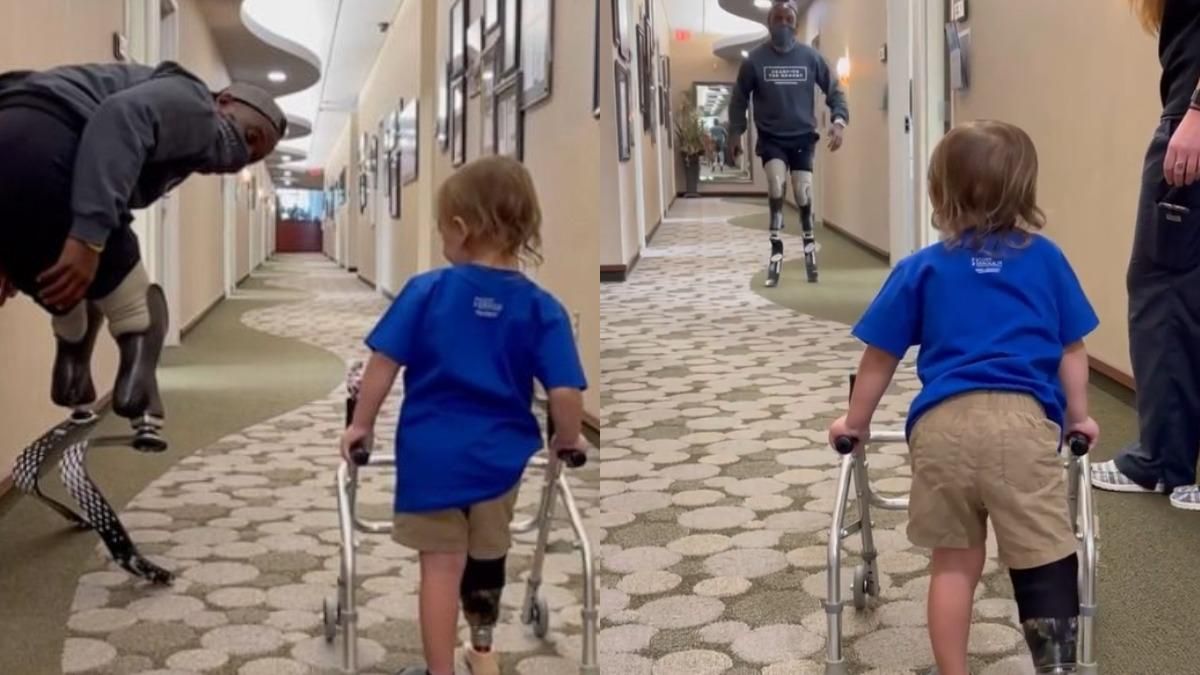 Перші кроки 2-річної дівчинки з протезом ноги: відео